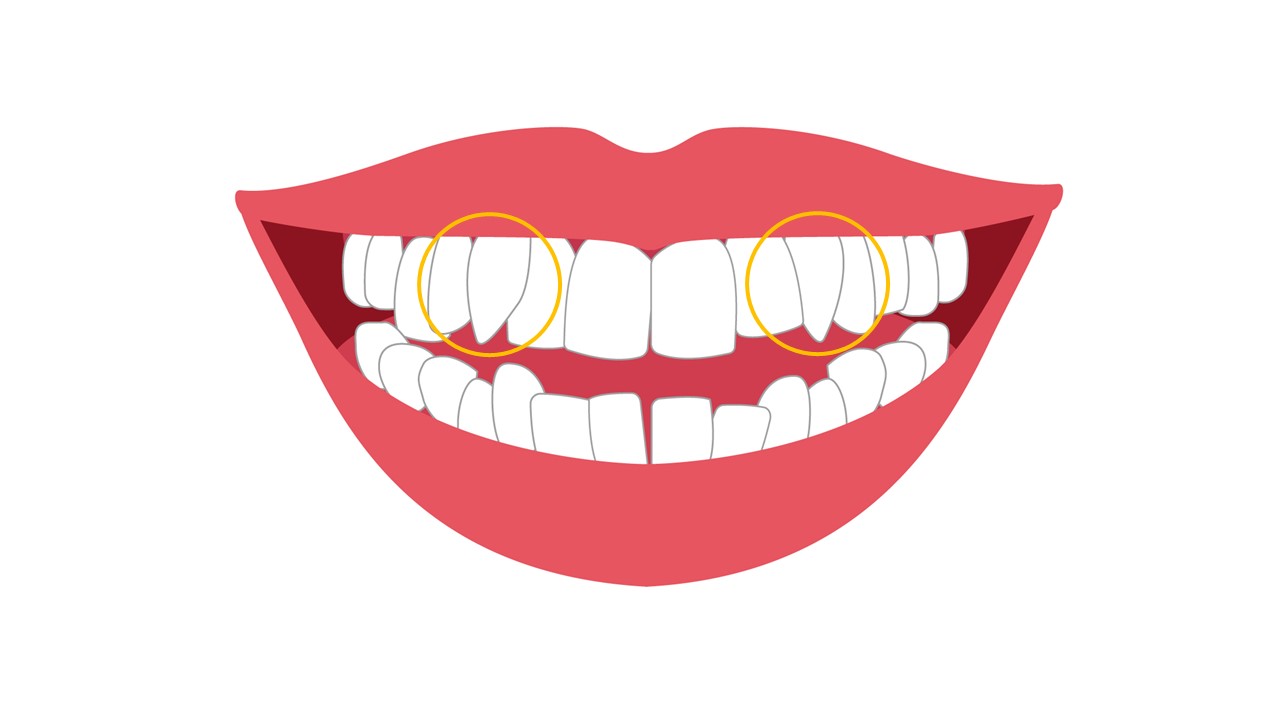 犬歯 と 八重歯 の 違い